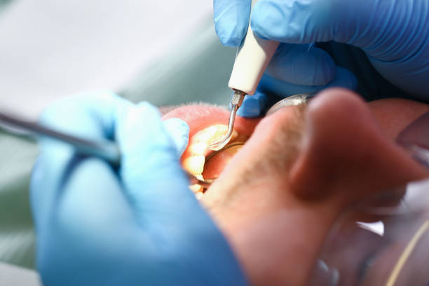 Best Emergency Tooth Extraction in Gordonsville, TN